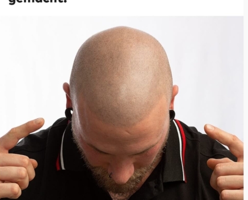 WELT: Haarpigmentierung - welche Erfahrung haben Männer mit der Methode gegen Haarausfall gemacht?