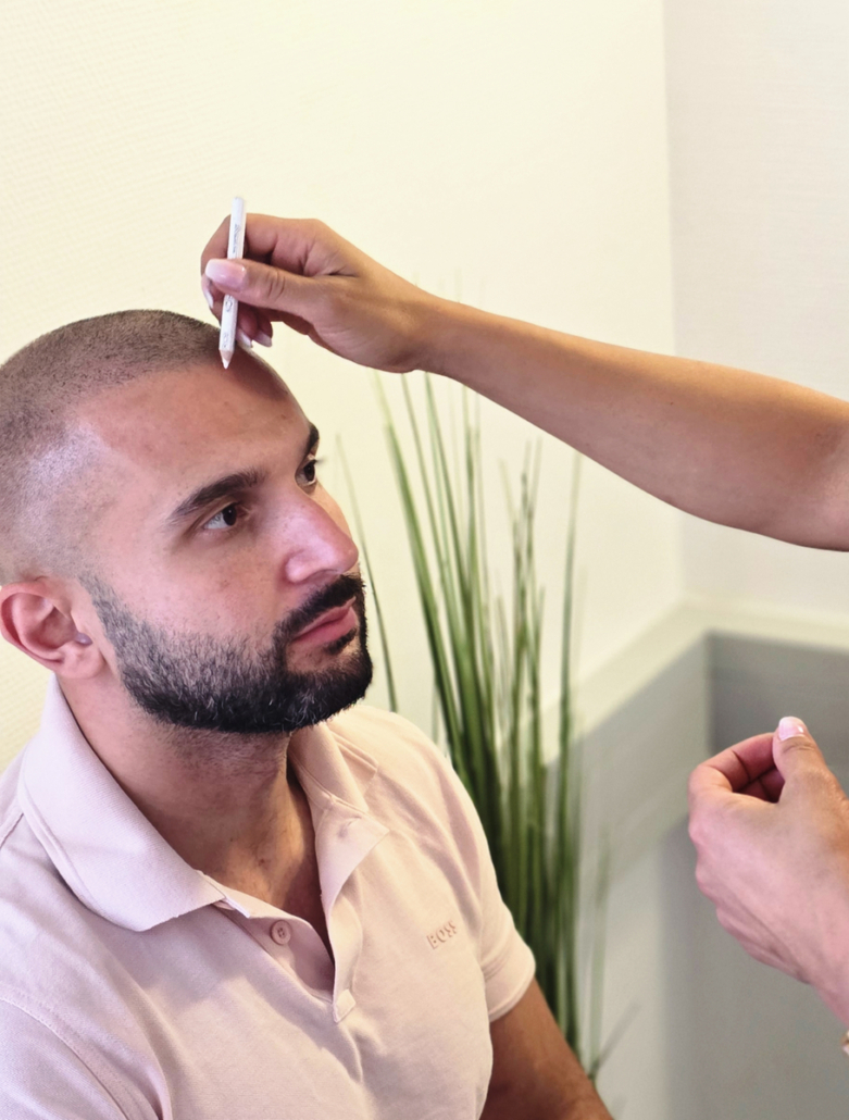 Haarpigmentierung Frankfurt – Fallbeispiel nach Haartransplantation Haarpigmentierung Frankfurt – Fallbeispiel nach Haartransplantation